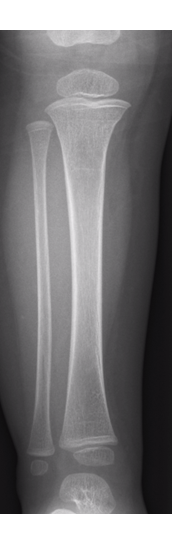 Proximal tibial buckle fracture