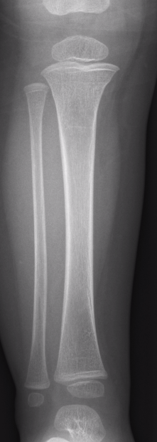 Proximal tibial buckle fracture