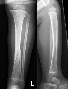 X-Ray of spiral fracture of tibia with minimal displacement