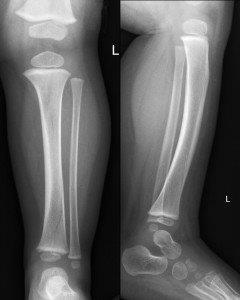 X-Ray of a toddler fracture. Not always apparent as in this X-Ray