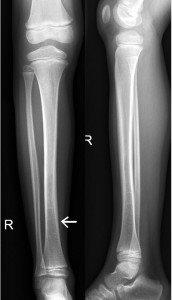 X-Ray of undisplaced transverse fracture of tibia. Highlighted by the arrow