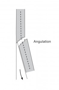 An image showing an angulated fracture