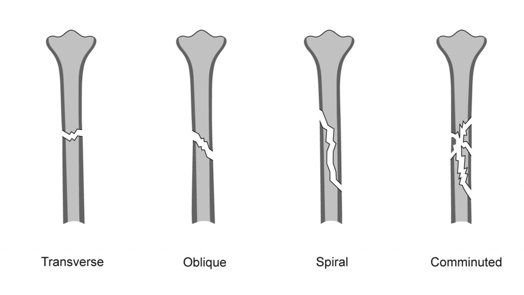 An image showing a series of complete fractures