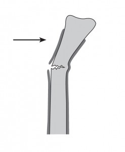 An image of a Greenstick fracture