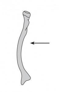 An image of plastic deformity or bowing of the paired long bone