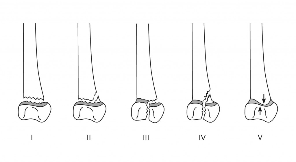 An image of Salter-Harris classification of fractures