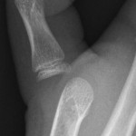 X-ray of thumb dislocation