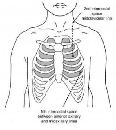 Insertion sites for intercostal catheter