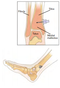 Intraosseous Access via the Distal tibia – 2-3cm above the medial malleolus