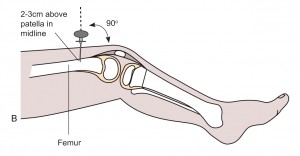 Intraosseous access of femur anatomy