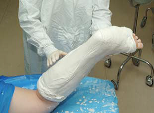 Below and above knee plaster slab