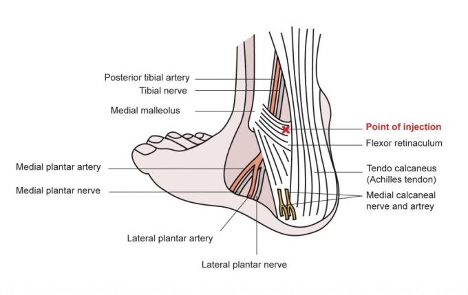 Posterior tibial nerve block injection site anatomy