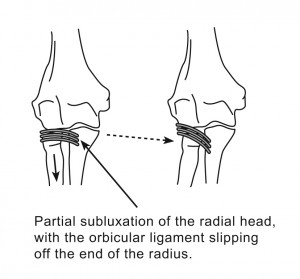 Partial subluxation of the radial head, with the orbital ligament slipping off the end of the radius