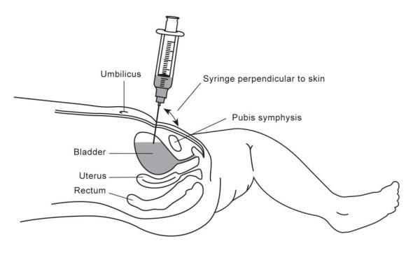 Position and technique for suprapubic aspiration of urine