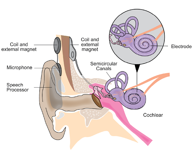 An illustration of the inner and outer ear demonstrating where the hearing implant elements are positioned after surgery